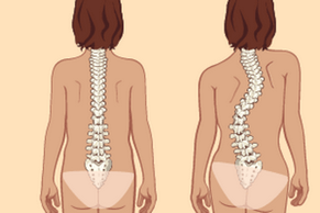 Erectile posture and scoliosis with thoracic osteochondrosis
