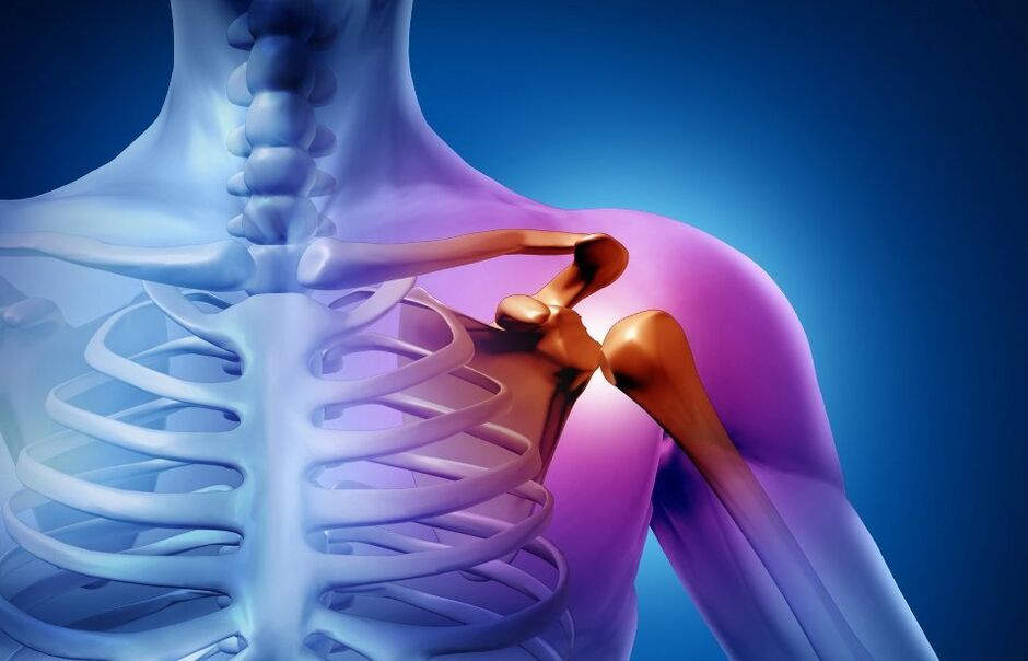 Injury of the shoulder joint due to arthrosis