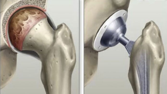 Hip replacement is performed at the last stage of coxarthrosis