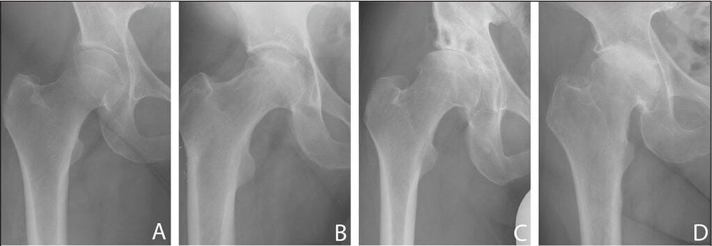 Stages of hip joint arthrosis development on X-ray