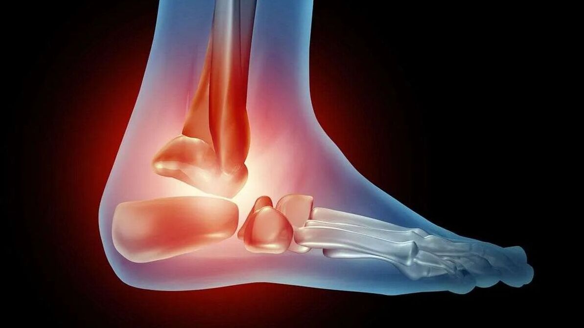 Diagram of ankle arthrosis