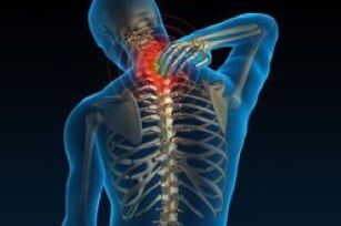 Cervical osteochondrosis causes neck pain