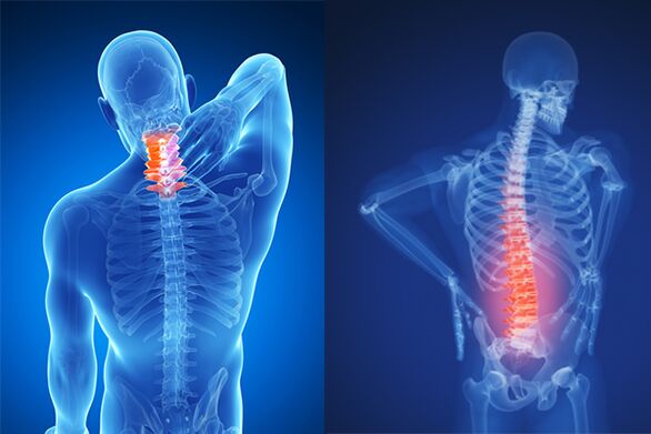 Osteochondrosis of cervical and lumbar spine