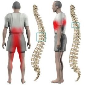 A rash in the spine
