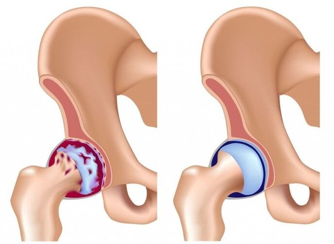 Hip joint damage due to arthrosis