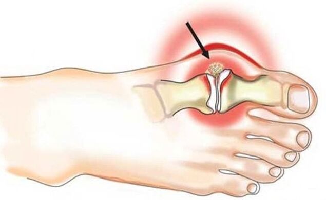 Inflammation of the big toe and big toe joint due to arthritis