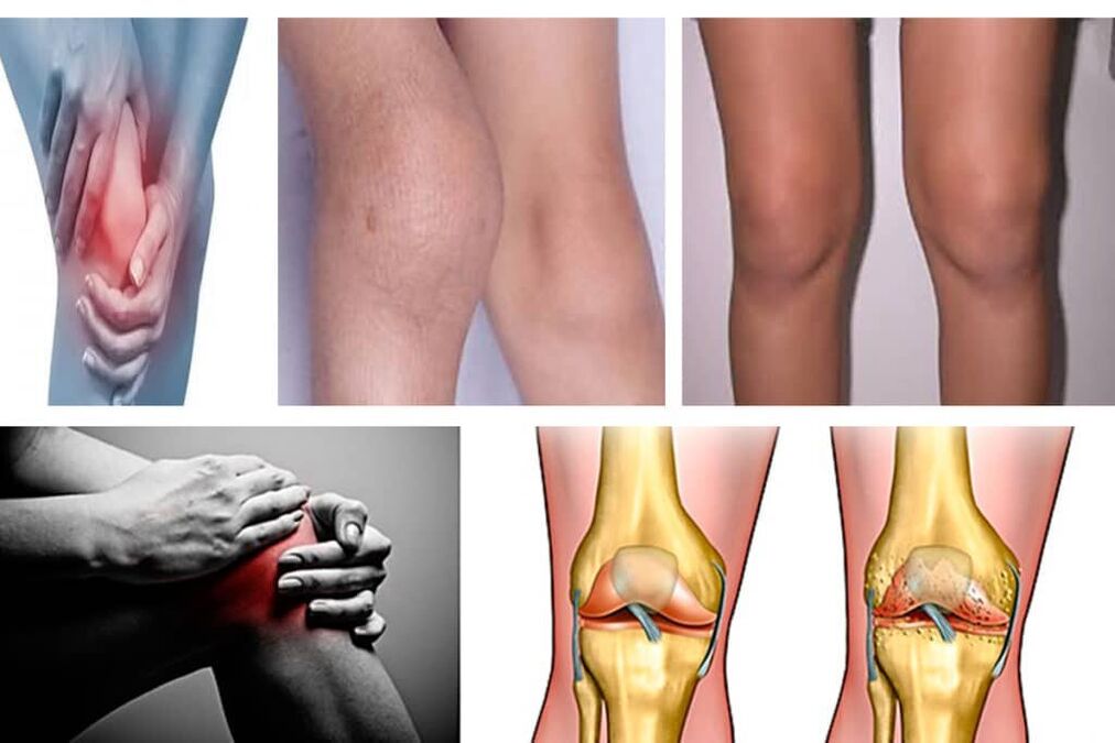 What is arthrosis