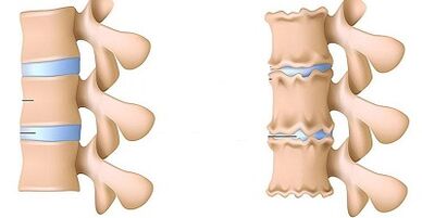 How to acknowledge the presence of lumbar osteochondrosis