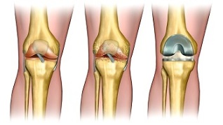 Arthroplasty for osteoarthritis of the knee joint